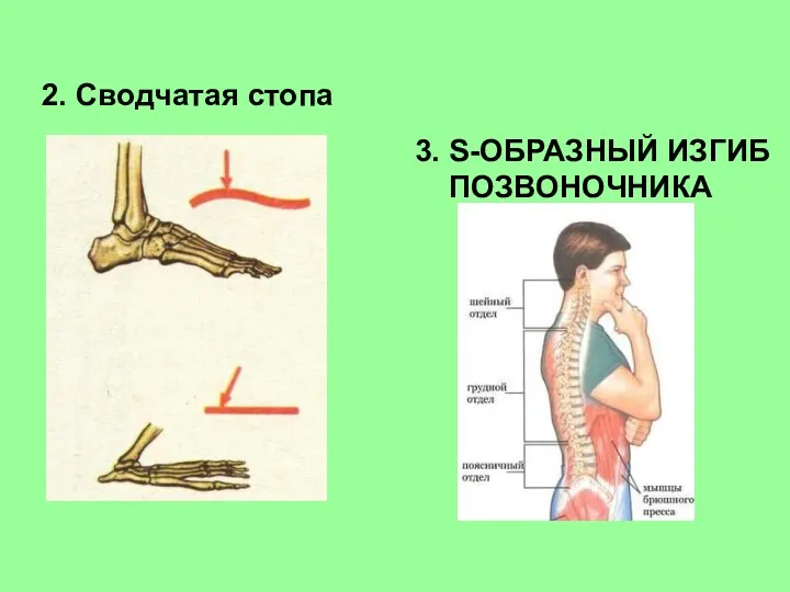 2. Сводчатая стопа 3. S-ОБРАЗНЫЙ ИЗГИБ ПОЗВОНОЧНИКА