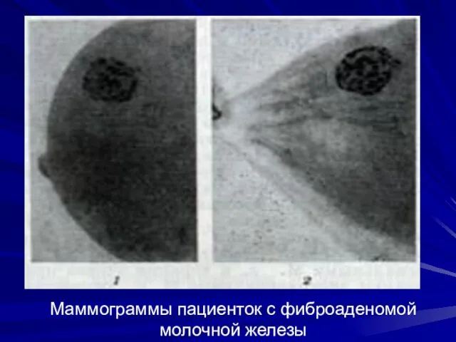 Маммограммы пациенток с фиброаденомой молочной железы