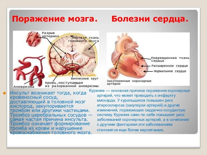 Поражение мозга. Болезни сердца. Инсульт возникает тогда, когда кровеносный сосуд, доставляющий в головной