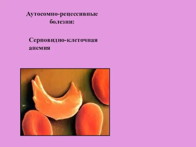 Серповидно-клеточная анемия Аутосомно-рецессивные болезни: