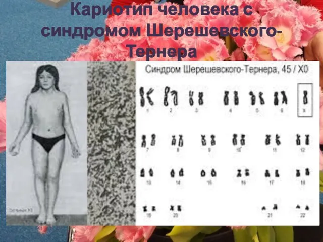 Кариотип человека с синдромом Шерешевского-Тернера