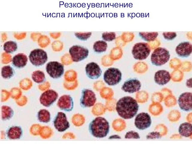 Резкое увеличение числа лимфоцитов в крови