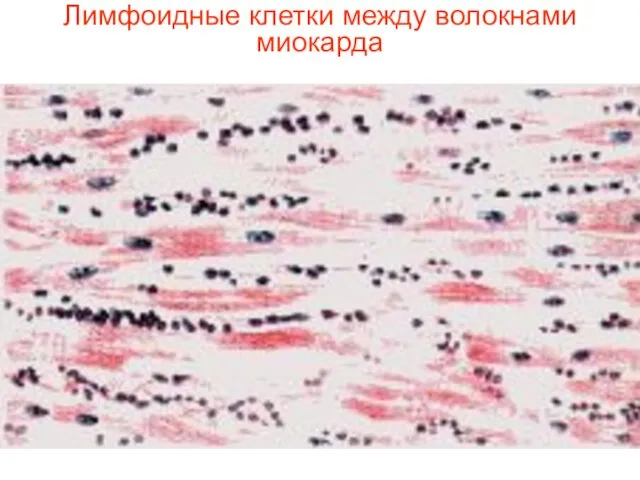 Лимфоидные клетки между волокнами миокарда