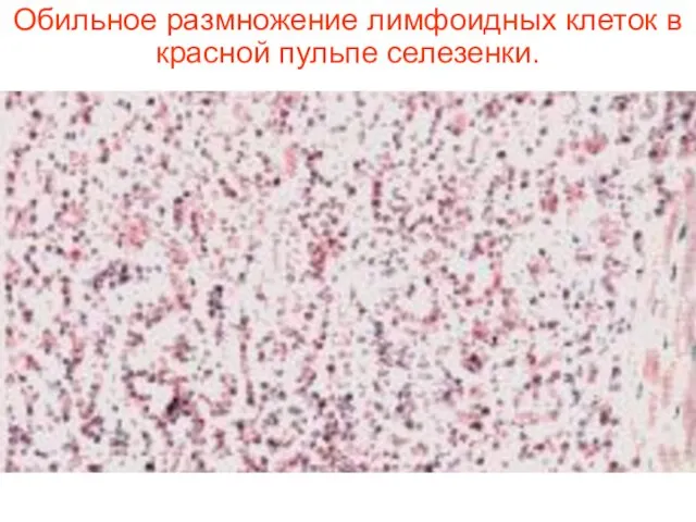 Обильное размножение лимфоидных клеток в красной пульпе селезенки.