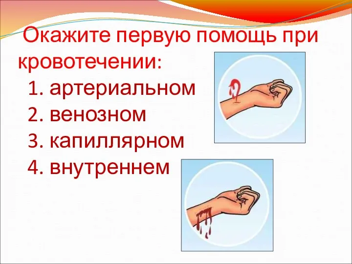 Окажите первую помощь при кровотечении: 1. артериальном 2. венозном 3. капиллярном 4. внутреннем