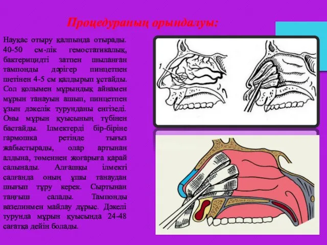 Процедураның орындалуы: Науқас отыру қалпында отырады. 40-50 см-лік гемостатикалық, бактерицидті