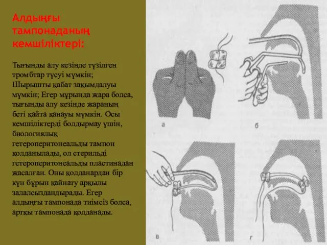 Алдыңғы тампонаданың кемшіліктері: Тығынды алу кезінде түзілген тромбтар түсуі мүмкін;