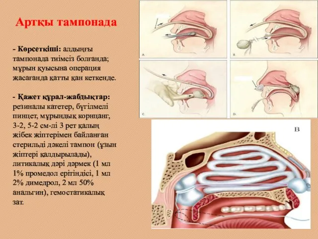 Артқы тампонада - Көрсеткіші: алдыңғы тампонада тиімсіз болғанда; мұрын қуысына