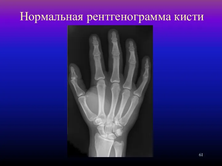 Нормальная рентгенограмма кисти