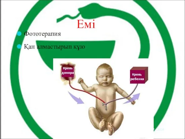 Емі Фототерапия Қан алмастырып құю AAP, 2004