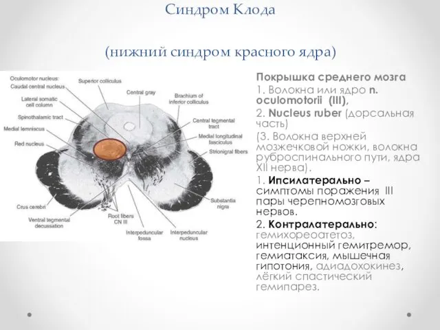 Синдром Клода (нижний синдром красного ядра) Покрышка среднего мозга 1.