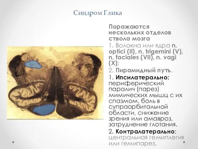 Синдром Глика Поражаются нескольких отделов ствола мозга 1. Волокна или