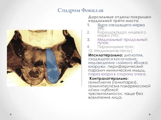 Стндром Фовилля Дорсальные отделы покрышки каудальной трети моста Ядра отводящего