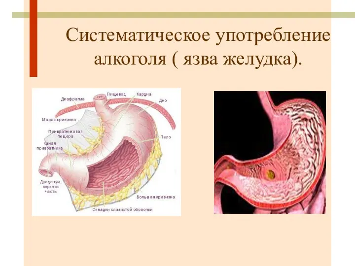 Систематическое употребление алкоголя ( язва желудка).