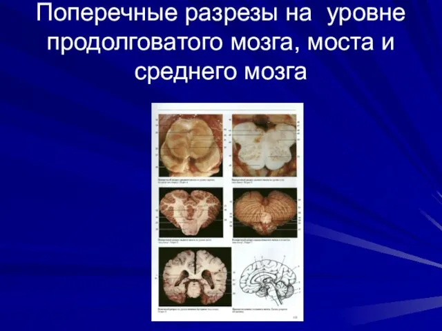 Поперечные разрезы на уровне продолговатого мозга, моста и среднего мозга