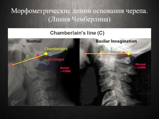 Морфометрические линии основания черепа. (Линия Чемберлина)