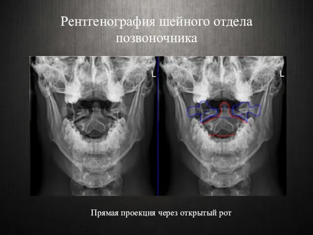 Рентгенография шейного отдела позвоночника Прямая проекция через открытый рот