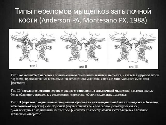 Типы переломов мыщелков затылочной кости (Anderson PA, Montesano PX, 1988)