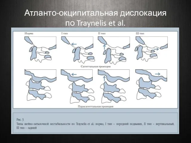 Атланто-окципитальная дислокация по Traynelis et al.