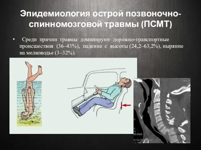 Эпидемиология острой позвоночно-спинномозговой травмы (ПСМТ) Среди причин травмы доминируют дорожно-транспортные