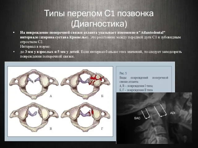 Типы перелом С1 позвонка (Диагностика) На повреждение поперечной связки атланта