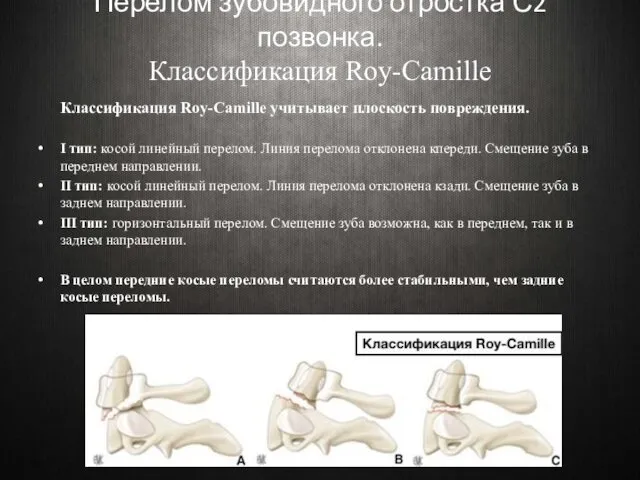 Перелом зубовидного отростка С2 позвонка. Классификация Roy-Camille Классификация Roy-Camille учитывает