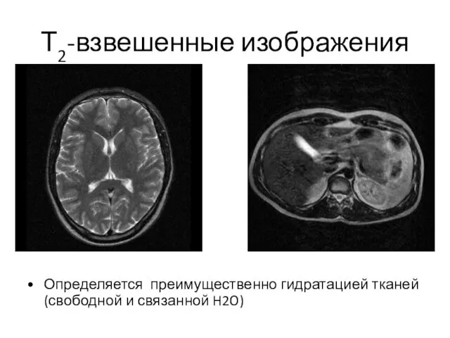 Т2-взвешенные изображения Определяется преимущественно гидратацией тканей (свободной и связанной H2O)