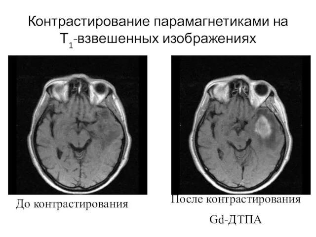 Контрастирование парамагнетиками на Т1-взвешенных изображениях После контрастирования Gd-ДТПА До контрастирования