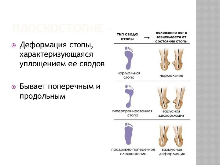 Плоскостопие - Деформация стопы, характеризующаяся уплощением ее сводов Бывает поперечным и продольным