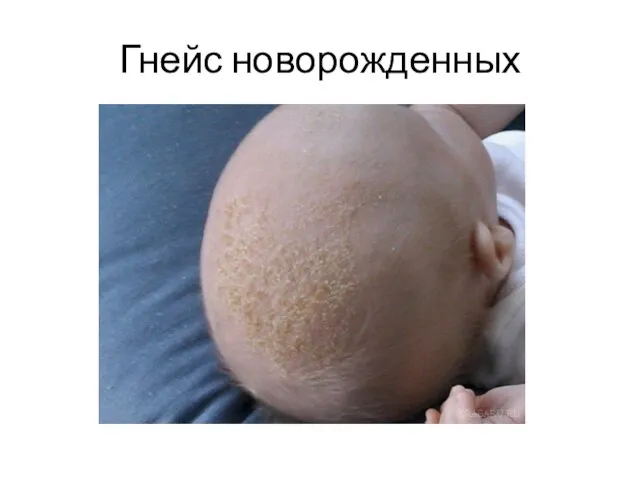 Гнейс новорожденных