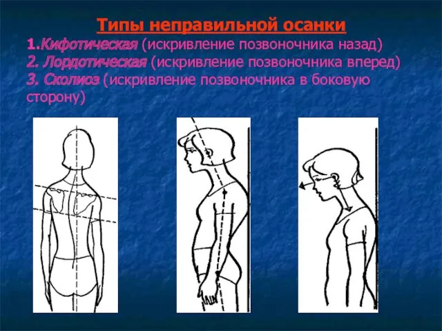 Типы неправильной осанки 1.Кифотическая (искривление позвоночника назад) 2. Лордотическая (искривление