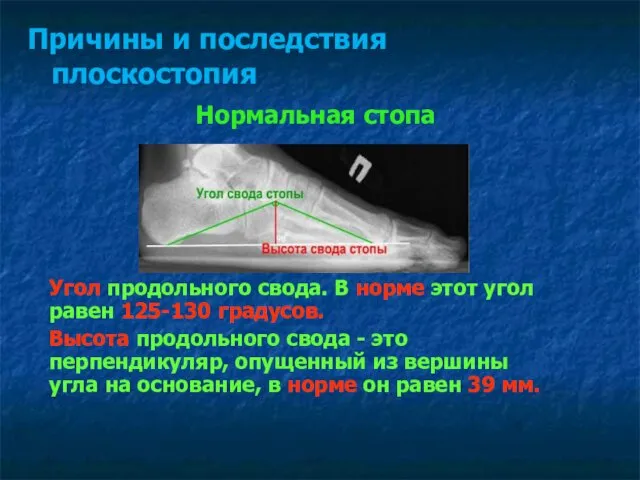 Нормальная стопа Причины и последствия плоскостопия Угол продольного свода. В