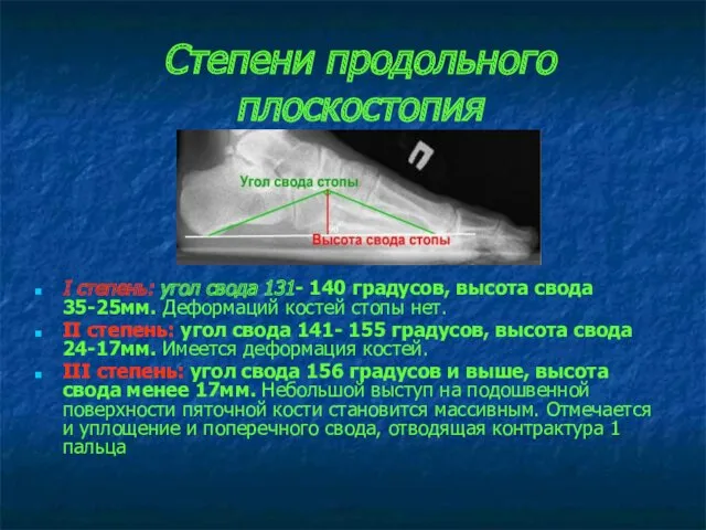 Степени продольного плоскостопия I степень: угол свода 131- 140 градусов,