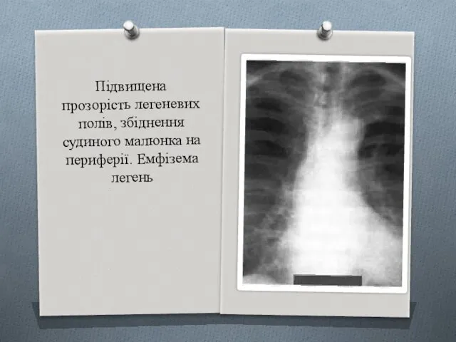 Підвищена прозорість легеневих полів, збіднення судиного малюнка на периферії. Емфізема легень