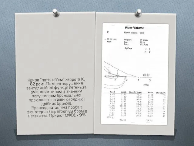 Крива "потік-об'єм" хворого К., 62 роки. Помірні порушення вентиляційної функції
