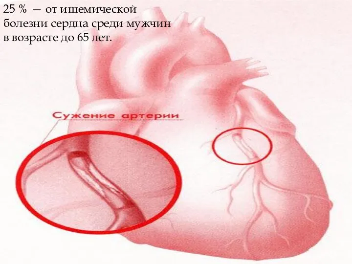 25 % — от ишемической болезни сердца среди мужчин в возрасте до 65 лет.