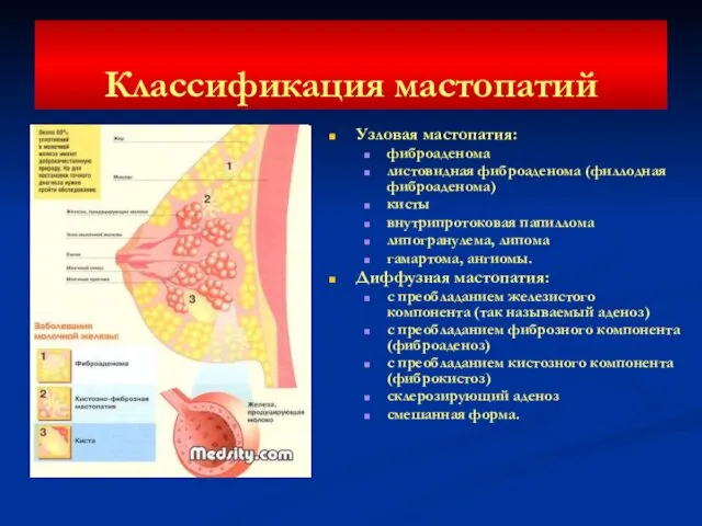 Классификация мастопатий Узловая мастопатия: фиброаденома листовидная фиброаденома (филлодная фиброаденома) кисты