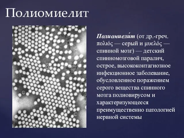 Полиомиелит Полиомиели́т (от др.-греч. πολιός — серый и µυελός — спинной мозг) —
