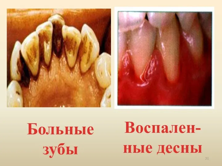 Больные зубы Воспален-ные десны