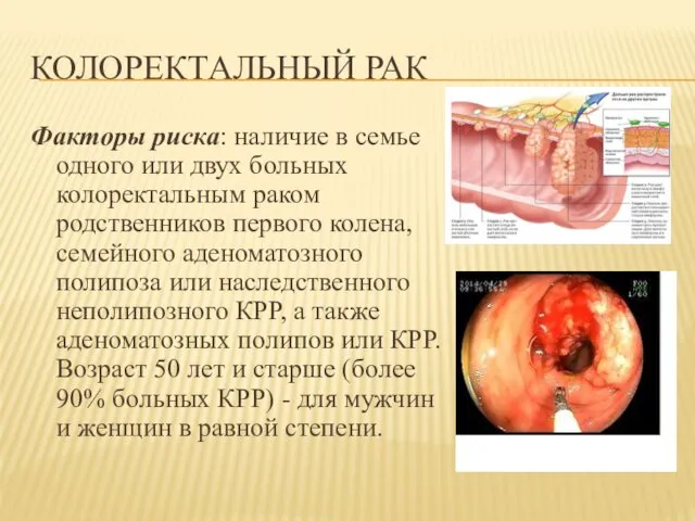 КОЛОРЕКТАЛЬНЫЙ РАК Факторы риска: наличие в семье одного или двух больных колоректальным раком