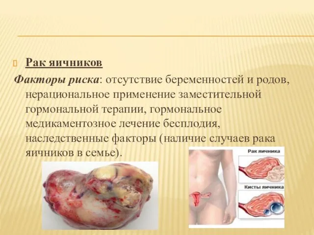 Рак яичников Факторы риска: отсутствие беременностей и родов, нерациональное применение