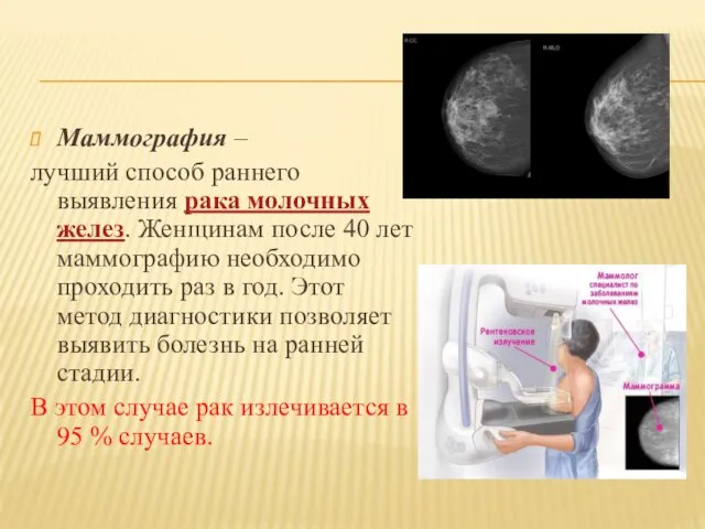 Маммография – лучший способ раннего выявления рака молочных желез. Женщинам после 40 лет