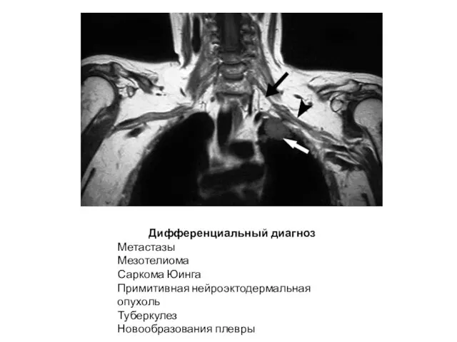 Дифференциальный диагноз Метастазы Мезотелиома Саркома Юинга Примитивная нейроэктодермальная опухоль Туберкулез Новообразования плевры