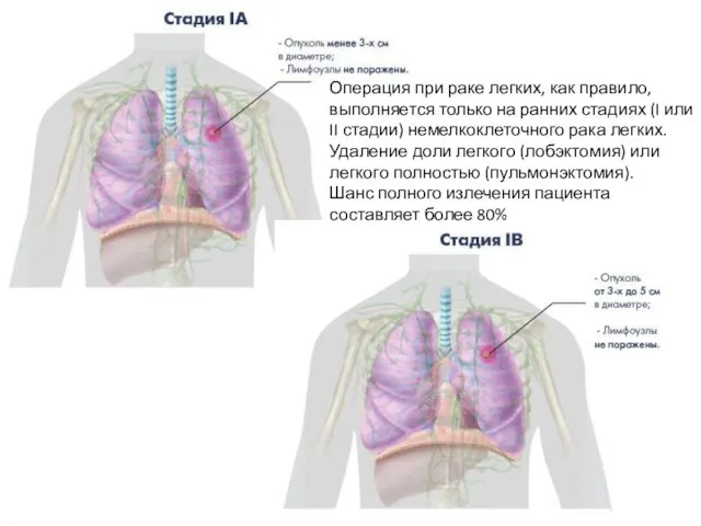 Операция при раке легких, как правило, выполняется только на ранних стадиях (I или