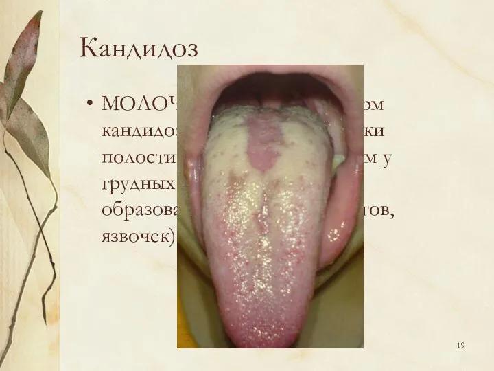 Кандидоз МОЛОЧНИЦА, одна из форм кандидоза слизистой оболочки полости рта, главным образом у
