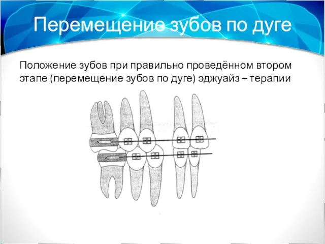 Перемещение зубов по дуге Положение зубов при правильно проведённом втором