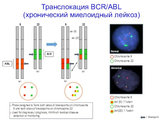 Транслокация BCR/ABL (хронический миелоидный лейкоз) ABL 9 22 BCR tel tel 9 22