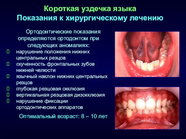Короткая уздечка языка Показания к хирургическому лечению Ортодонтические показания определяются