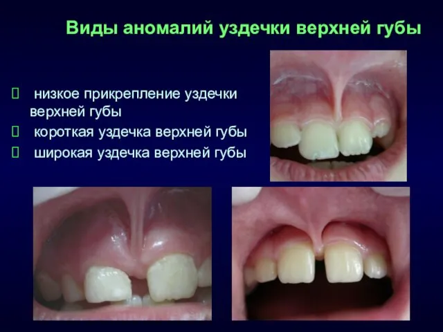 Виды аномалий уздечки верхней губы низкое прикрепление уздечки верхней губы