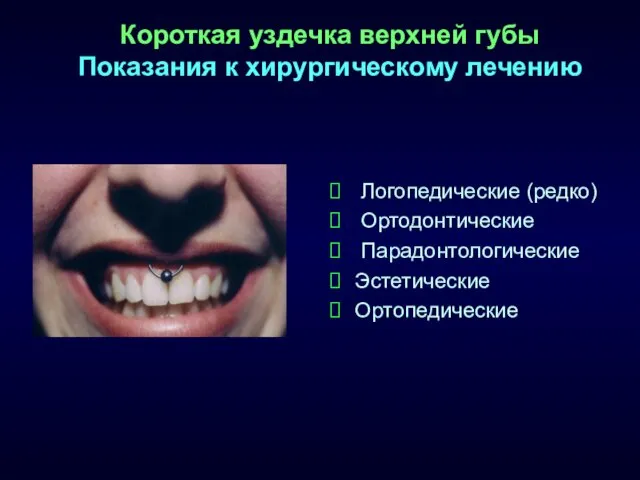 Короткая уздечка верхней губы Показания к хирургическому лечению Логопедические (редко) Ортодонтические Парадонтологические Эстетические Ортопедические